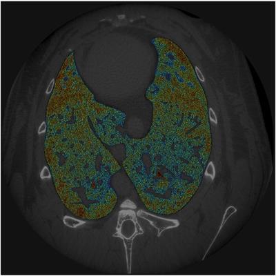 Regional Behavior of Airspaces During Positive Pressure Reduction Assessed by Synchrotron Radiation Computed Tomography